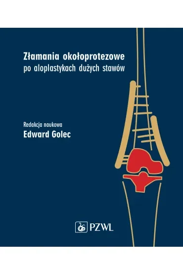 Złamania okołoprotezowe po aloplastykach dużych stawów